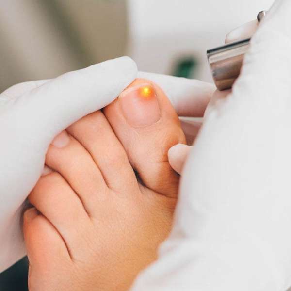 Laser Treatment for Toenail Fungus