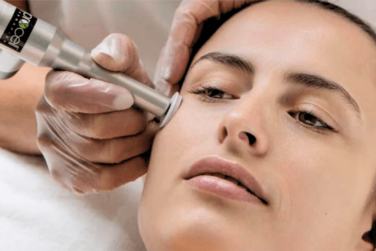 Microneedling