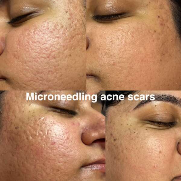 acne
