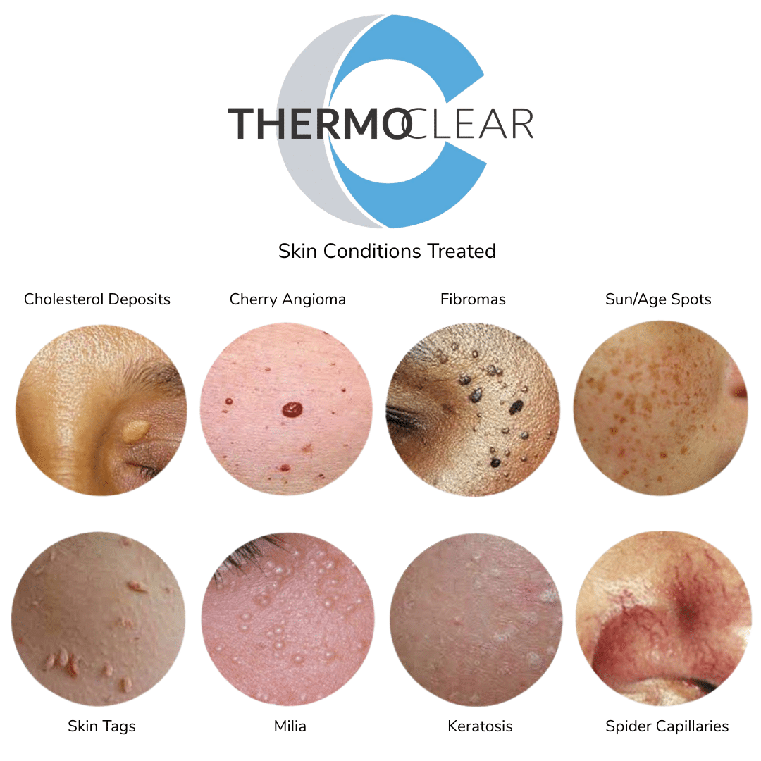 Thermoclear